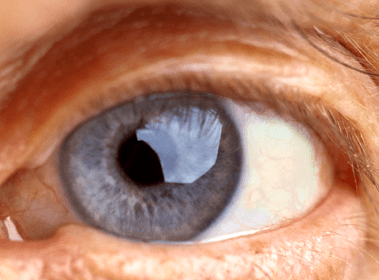 Факоэмульсификация катаракты с имплантацией иол