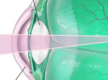 Искусственные хрусталики при катаракте