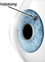 Операция глаукомы лазером